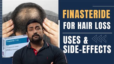finasteride for hair loss side effects